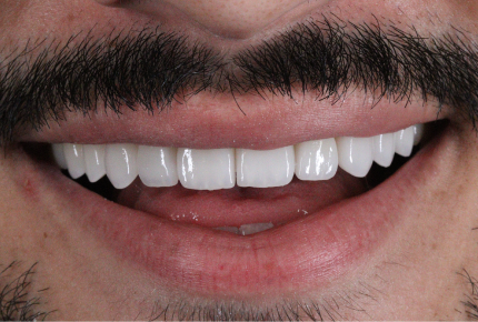 Facetas Dentárias